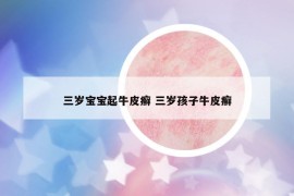 三歲寶寶起牛皮癬 三歲孩子牛皮癬