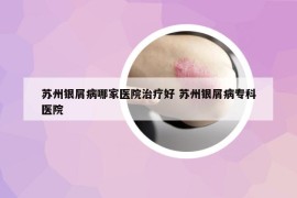 蘇州銀屑病哪家醫(yī)院治療好 蘇州銀屑病?？漆t(yī)院