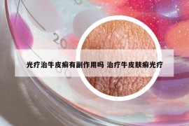 光療治牛皮癬有副作用嗎 治療牛皮膚癬光療