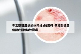 尋常型銀屑病能吃阿維a膠囊嗎 尋常型銀屑病能吃阿維a膠囊嗎