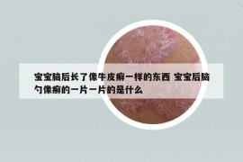 寶寶腦后長了像牛皮癬一樣的東西 寶寶后腦勺像癬的一片一片的是什么