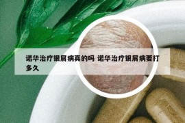 諾華治療銀屑病真的嗎 諾華治療銀屑病要打多久