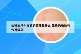 生粉治療牛皮癬的原理是什么 生粉的功效與作用禁忌