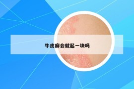 牛皮癬會(huì)就起一塊嗎