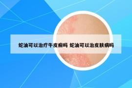 蛇油可以治療牛皮癬嗎 蛇油可以治皮膚病嗎