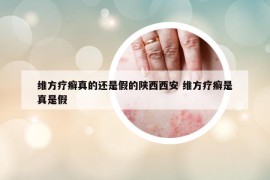 維方療癬真的還是假的陜西西安 維方療癬是真是假