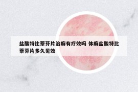 鹽酸特比萘芬片治癬有療效嗎 體癬鹽酸特比萘芬片多久見效