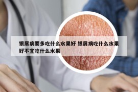 銀屑病要多吃什么水果好 銀屑病吃什么水果好不宜吃什么水果