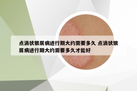點(diǎn)滴狀銀屑病進(jìn)行期大約需要多久 點(diǎn)滴狀銀屑病進(jìn)行期大約需要多久才能好