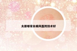 太原哪家白癜風(fēng)醫(yī)院技術(shù)好