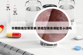 孕期膿皰型銀屑病 膿皰型銀屑病能生小孩嗎