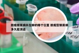 膿皰銀屑病長在腳的哪個位置 膿皰型銀屑病多久能消退