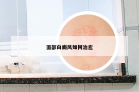 面部白癜風(fēng)如何治愈