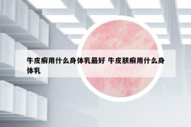 牛皮癬用什么身體乳最好 牛皮膚癬用什么身體乳
