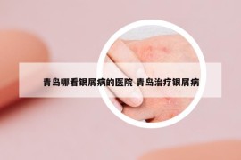 青島哪看銀屑病的醫(yī)院 青島治療銀屑病