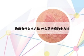 治癬有什么土方法 什么藥治癬的土方法