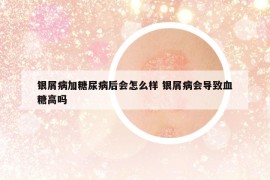 銀屑病加糖尿病后會怎么樣 銀屑病會導(dǎo)致血糖高嗎