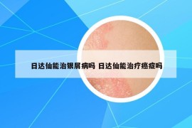 日達(dá)仙能治銀屑病嗎 日達(dá)仙能治療癌癥嗎