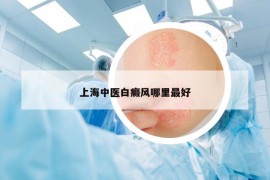 上海中醫(yī)白癜風(fēng)哪里最好