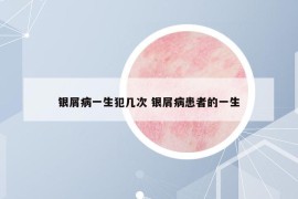 銀屑病一生犯幾次 銀屑病患者的一生