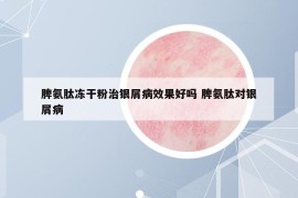 脾氨肽凍干粉治銀屑病效果好嗎 脾氨肽對銀屑病