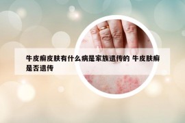 牛皮癬皮膚有什么病是家族遺傳的 牛皮膚癬是否遺傳