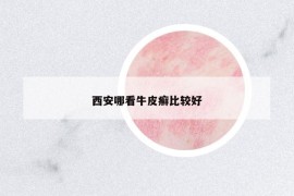 西安哪看牛皮癬比較好