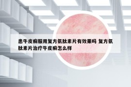 患牛皮癬服用復方氨肽素片有效果嗎 復方氨肽素片治療牛皮癬怎么樣