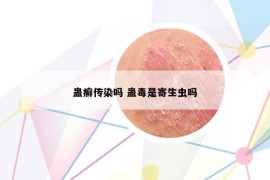 蠱癬傳染嗎 蠱毒是寄生蟲嗎