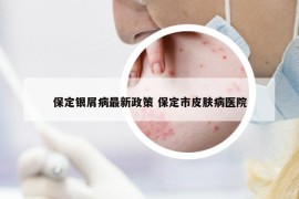 保定銀屑病最新政策 保定市皮膚病醫(yī)院