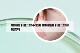 銀屑病卡泊三醇不管用 銀屑病用卡泊三醇會脫皮嗎