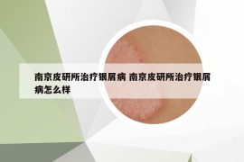 南京皮研所治療銀屑病 南京皮研所治療銀屑病怎么樣