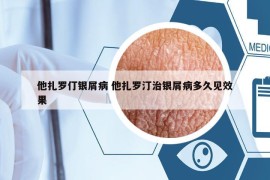 他扎羅仃銀屑病 他扎羅汀治銀屑病多久見效果