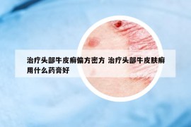 治療頭部牛皮癬偏方密方 治療頭部牛皮膚癬用什么藥膏好