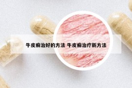 牛皮癬治好的方法 牛皮癬治療新方法
