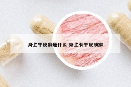 身上牛皮癬是什么 身上有牛皮膚癬