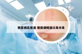 銀屑病高度酒 銀屑病喝酒以毒攻毒