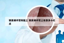 銀屑病手臂和腿上 銀屑病手臂上有很多小紅點(diǎn)
