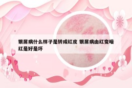 銀屑病什么樣子是轉(zhuǎn)成紅皮 銀屑病由紅變暗紅是好是壞