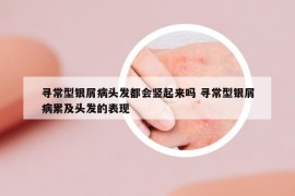 尋常型銀屑病頭發(fā)都會豎起來嗎 尋常型銀屑病累及頭發(fā)的表現(xiàn)