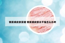 銀屑病皮膚緊繃 銀屑病皮膚太干燥怎么辦啊
