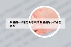 銀屑病小紅包怎么老不好 銀屑病起小紅點怎么辦