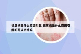 銀屑病是什么原因引起 銀屑病是什么原因引起的可以治療嗎