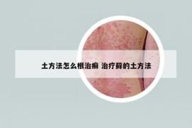 土方法怎么根治癬 治療蘚的土方法