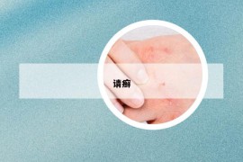 請癬