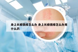 身上長(zhǎng)癬很癢怎么辦 身上長(zhǎng)癬很癢怎么辦用什么藥