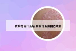 皮癬是因什么起 皮癬什么原因造成的