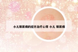 小兒銀屑病的經(jīng)方治療心得 小兒 銀屑病