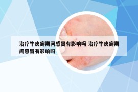 治療牛皮癬期間感冒有影響嗎 治療牛皮癬期間感冒有影響嗎