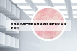 牛皮癬患者吃美托洛爾可以嗎 牛皮癬可以吃激素嗎
